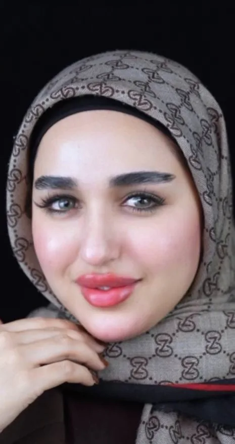 حقن فيلر كامل الوجه - بعد
