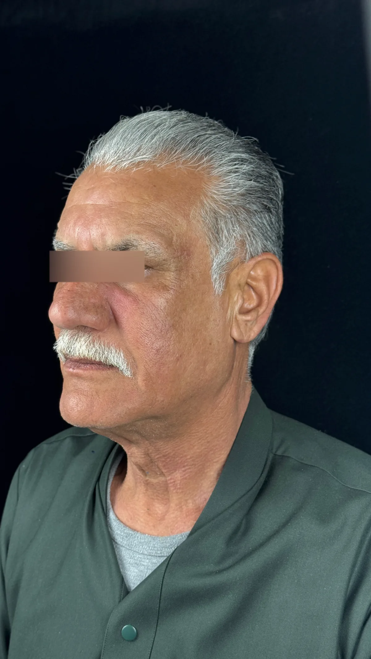 شد البشرة - بجهاز الترا كلير - بعد